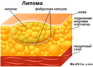 Строение липомы