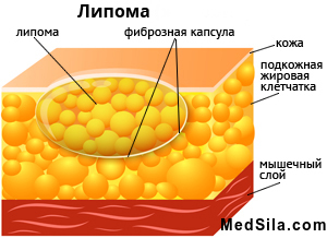 Строение липомы